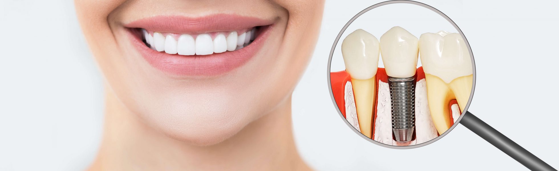 Dental Implants in Mesa: What You Need to Know