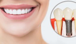Dental Implants in Mesa: What You Need to Know
